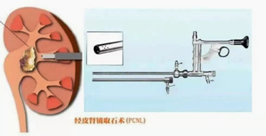不懂經(jīng)皮腎鏡是什么？軒科告訴你！